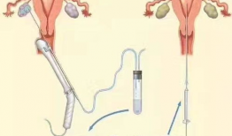 人工授精视频,科技助力生育新篇章